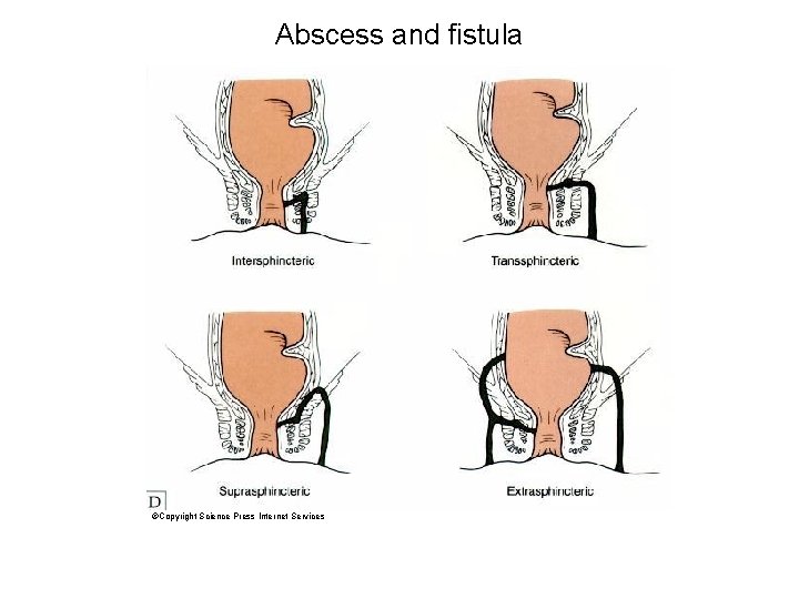 Abscess and fistula ©Copyright Science Press Internet Services 