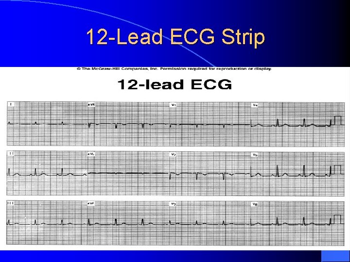 12 -Lead ECG Strip 