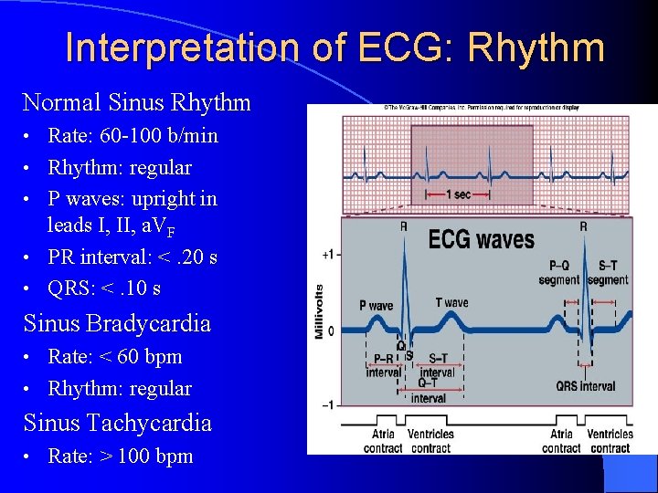 Interpretation of ECG: Rhythm Normal Sinus Rhythm • • • Rate: 60 -100 b/min