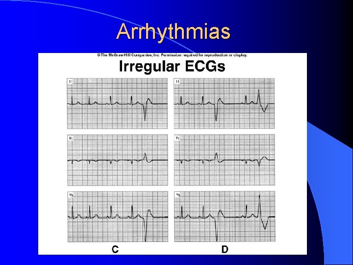 Arrhythmias 