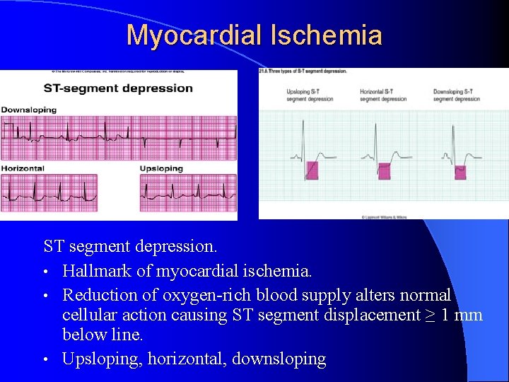 Myocardial Ischemia ST segment depression. • Hallmark of myocardial ischemia. • Reduction of oxygen-rich