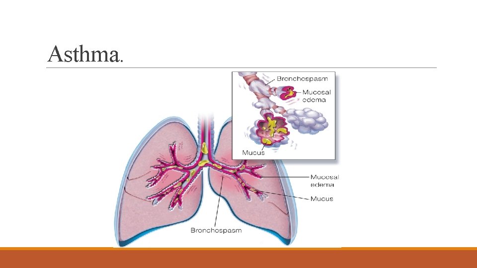 Asthma. 