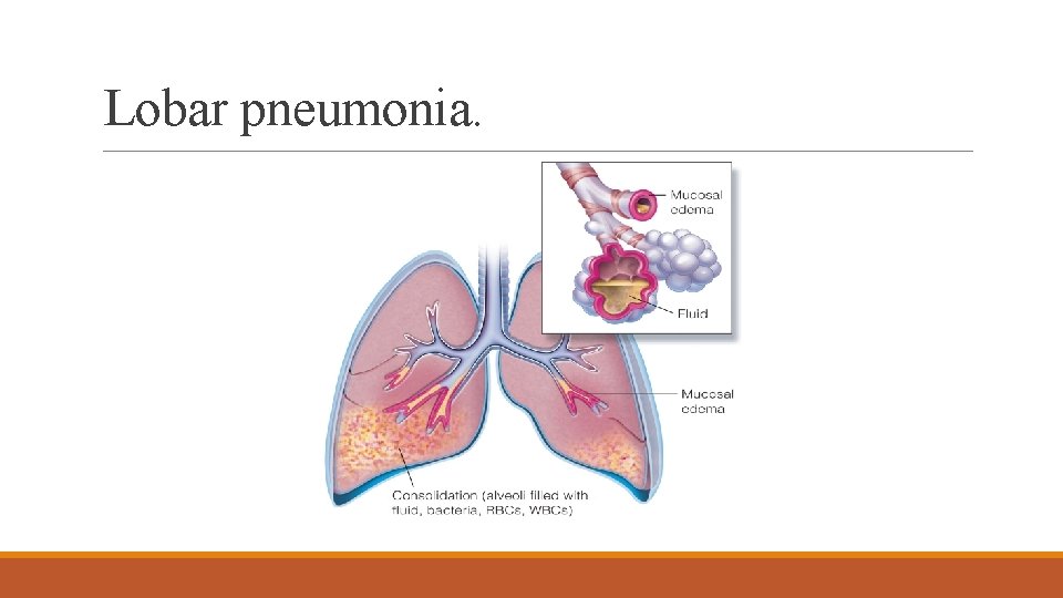 Lobar pneumonia. 