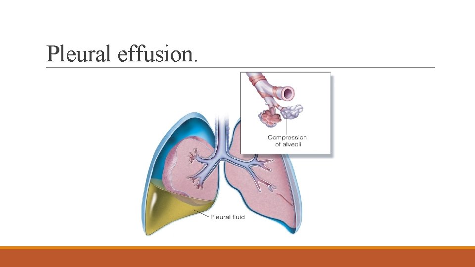 Pleural effusion. 