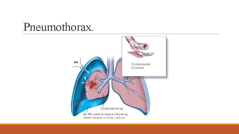 Pneumothorax. 
