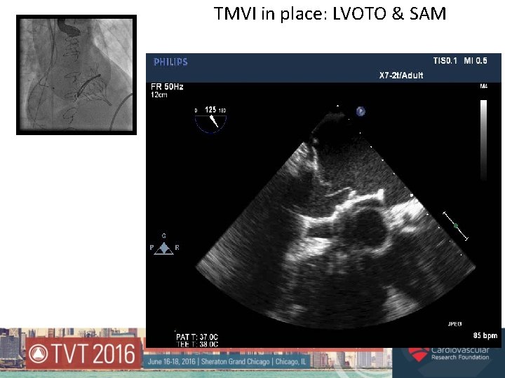 TMVI in place: LVOTO & SAM 