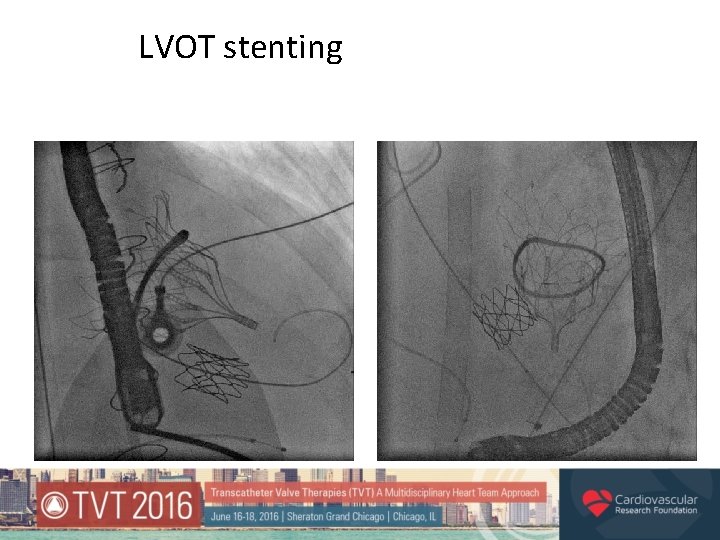 LVOT stenting 