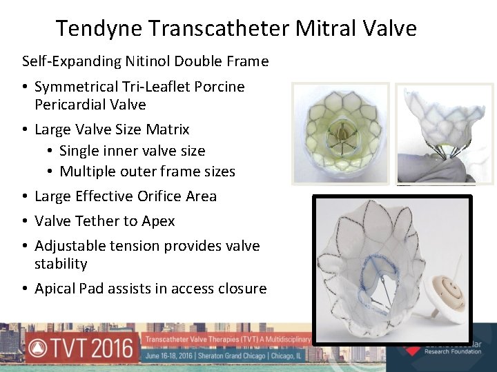Tendyne Transcatheter Mitral Valve Self-Expanding Nitinol Double Frame • Symmetrical Tri-Leaflet Porcine Pericardial Valve