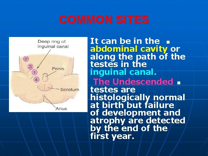 COMMON SITES It can be in the n abdominal cavity or along the path COMMON SITES It can be in the n abdominal cavity or along the path