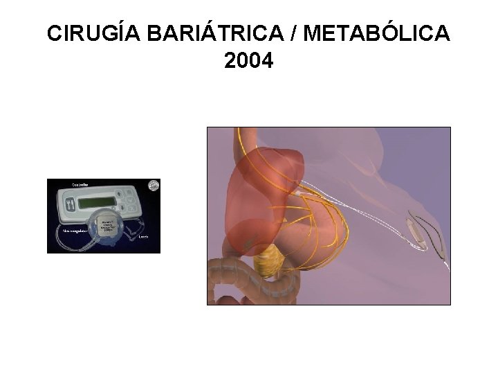 CIRUGÍA BARIÁTRICA / METABÓLICA 2004 