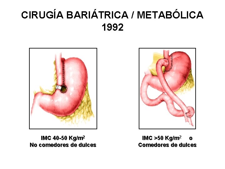 CIRUGÍA BARIÁTRICA / METABÓLICA 1992 IMC 40 -50 Kg/m 2 No comedores de dulces