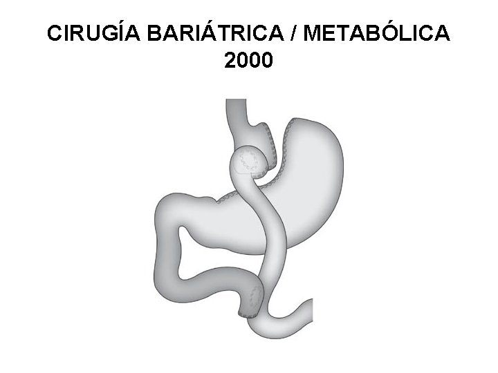 CIRUGÍA BARIÁTRICA / METABÓLICA 2000 