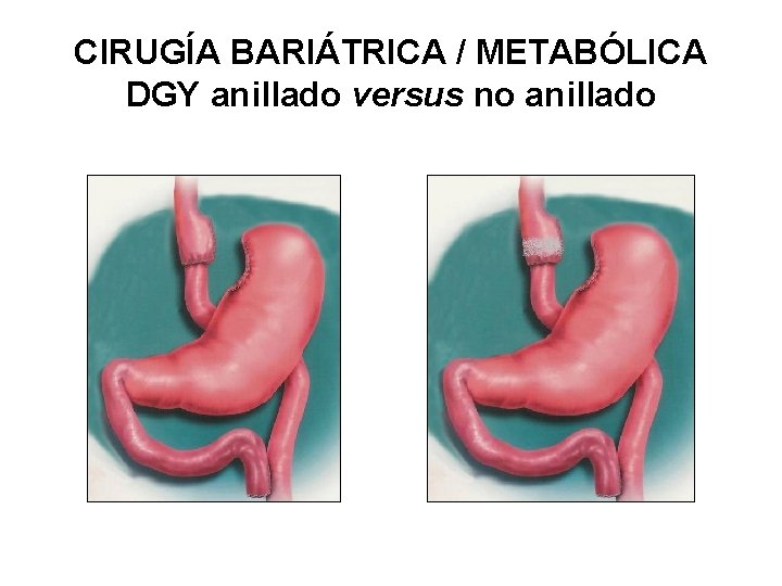 CIRUGÍA BARIÁTRICA / METABÓLICA DGY anillado versus no anillado 