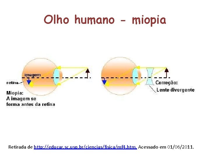 Olho humano - miopia Retirada de http: //educar. sc. usp. br/ciencias/fisica/mf 4. htm. Acessado