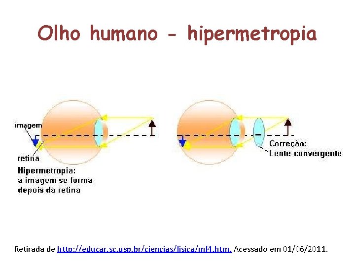 Olho humano - hipermetropia Retirada de http: //educar. sc. usp. br/ciencias/fisica/mf 4. htm. Acessado