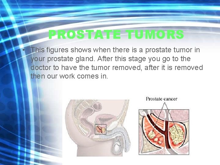 PROSTATE TUMORS • This figures shows when there is a prostate tumor in your