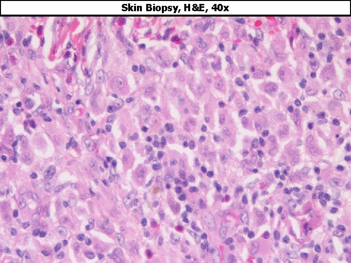 Uncommon Histiocytic Disorders Skin Lesion in an Infant