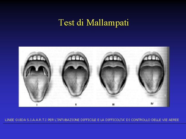 Test di Mallampati LINEE GUIDA S. I. A. A. R. T. I PER L'INTUBAZIONE