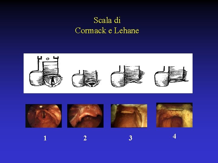 Scala di Cormack e Lehane 1 2 3 4 
