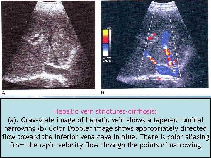 Hepatic vein strictures-cirrhosis: (a). Gray-scale image of hepatic vein shows a tapered luminal narrowing