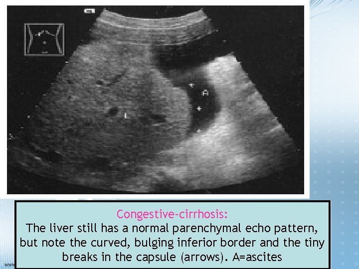 Congestive-cirrhosis: The liver still has a normal parenchymal echo pattern, but note the curved,