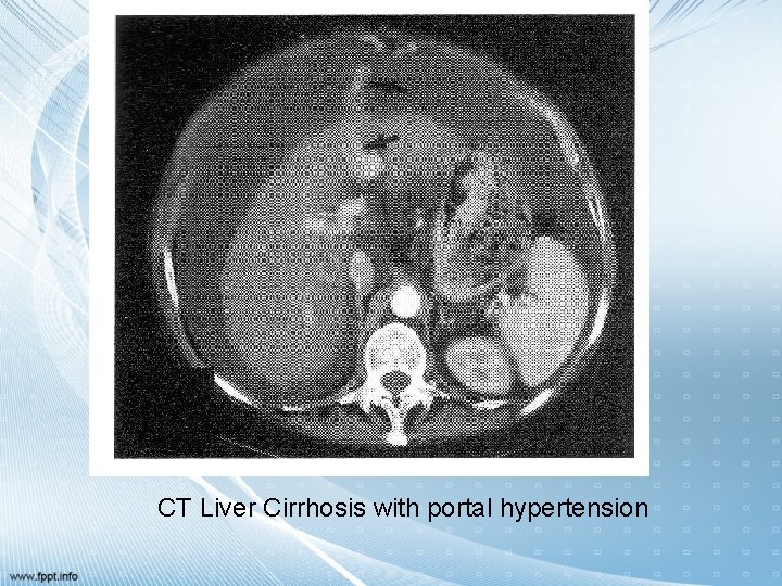 CT Liver Cirrhosis with portal hypertension 