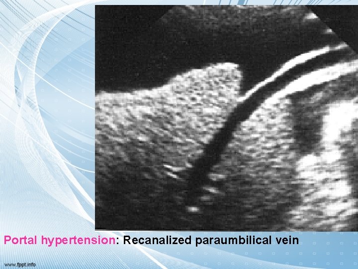 Portal hypertension: Recanalized paraumbilical vein 