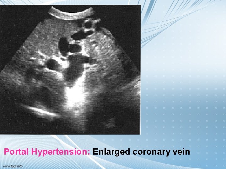 Portal Hypertension: Enlarged coronary vein 