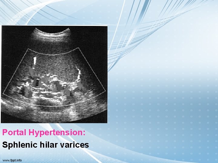 Portal Hypertension: Sphlenic hilar varices 