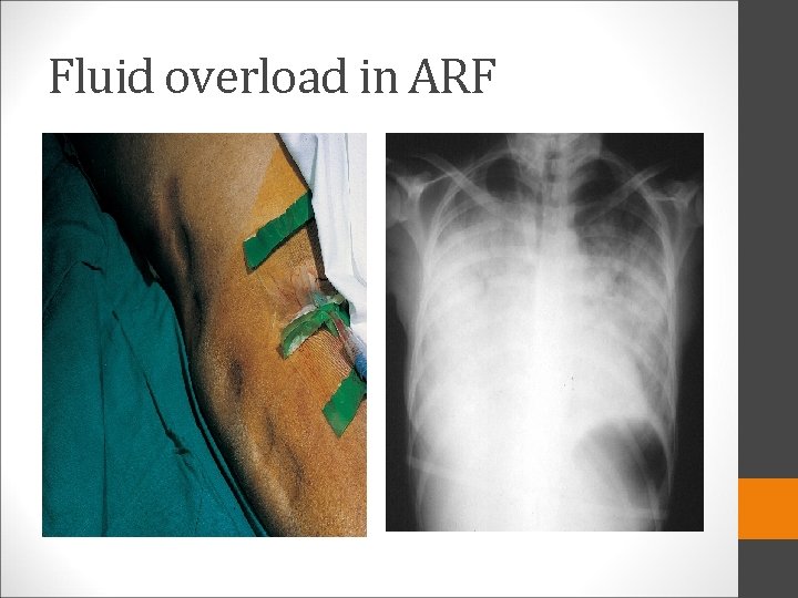 Fluid overload in ARF 