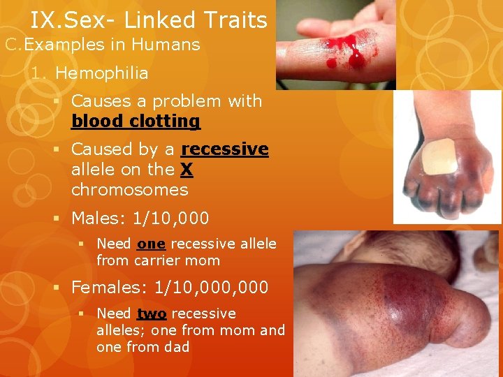 IX. Sex- Linked Traits C. Examples in Humans 1. Hemophilia § Causes a problem