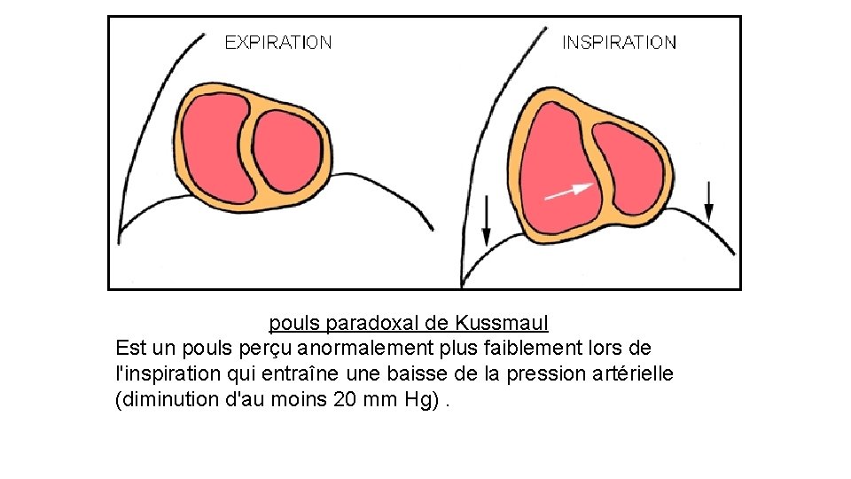 pouls paradoxal de Kussmaul Est un pouls perçu anormalement plus faiblement lors de l'inspiration