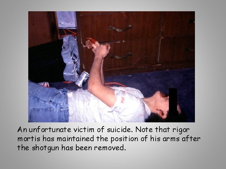 An unfortunate victim of suicide. Note that rigor mortis has maintained the position of