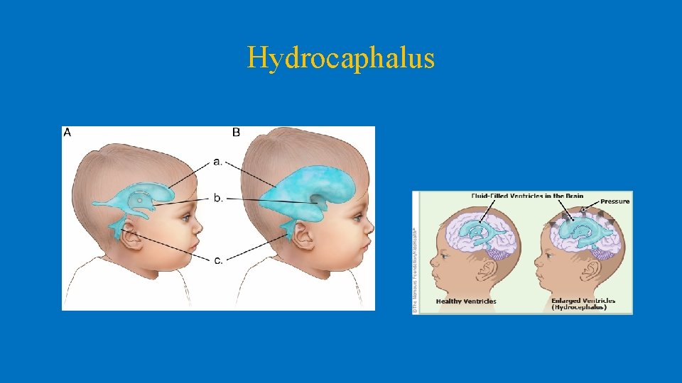 Hydrocaphalus 