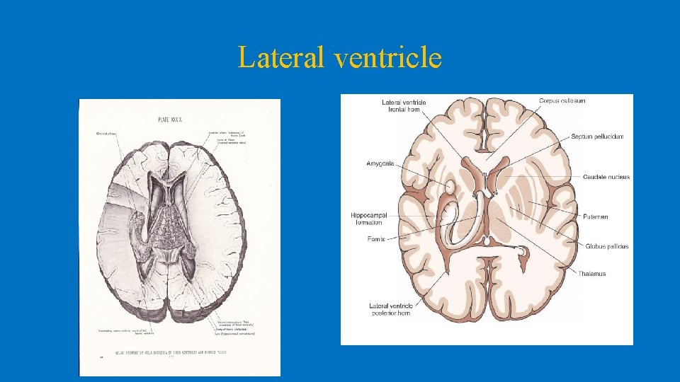 Lateral ventricle 