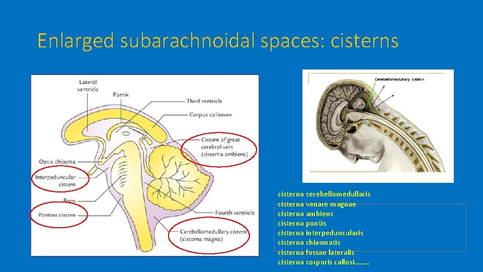 Enlarged subarachnoidal spaces: cisterns cisterna cerebellomedullaris cisterna venare magnae cisterna ambiens cisterna pontis cisterna