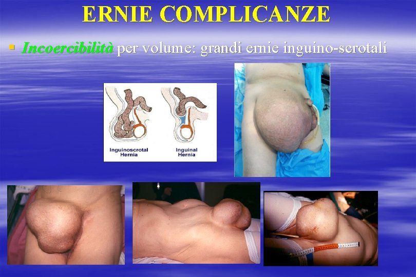 ERNIE COMPLICANZE § Incoercibilità per volume: grandi ernie inguino-scrotali 