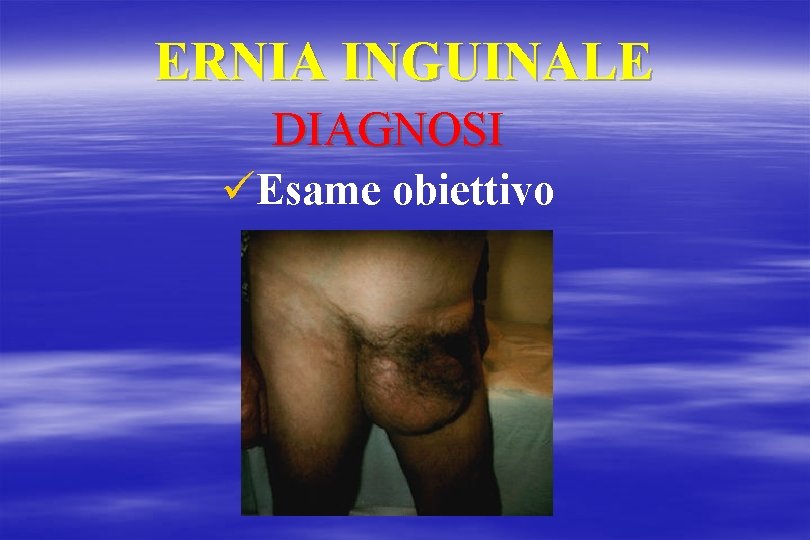 ERNIA INGUINALE DIAGNOSI üEsame obiettivo 