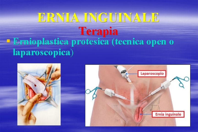 ERNIA INGUINALE Terapia § Ernioplastica protesica (tecnica open o laparoscopica) 