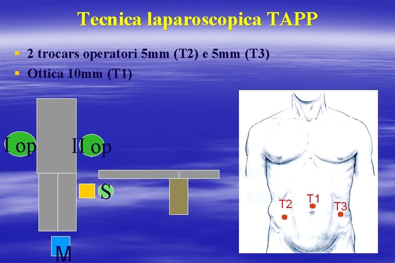 Tecnica laparoscopica TAPP § 2 trocars operatori 5 mm (T 2) e 5 mm