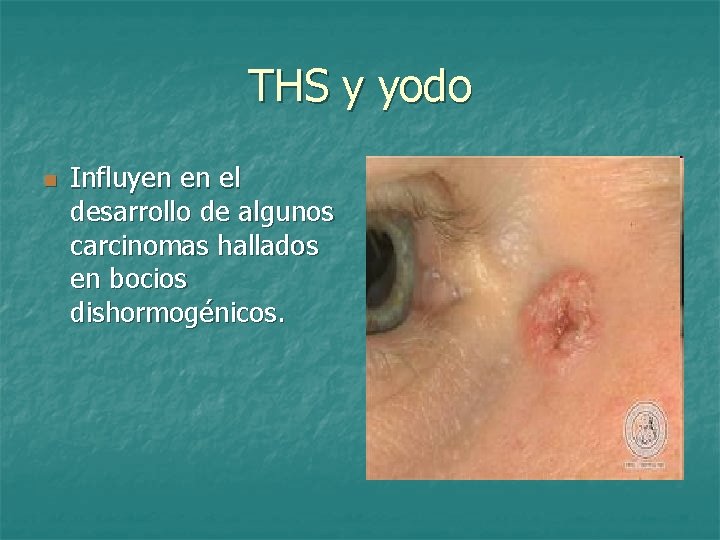 THS y yodo n Influyen en el desarrollo de algunos carcinomas hallados en bocios