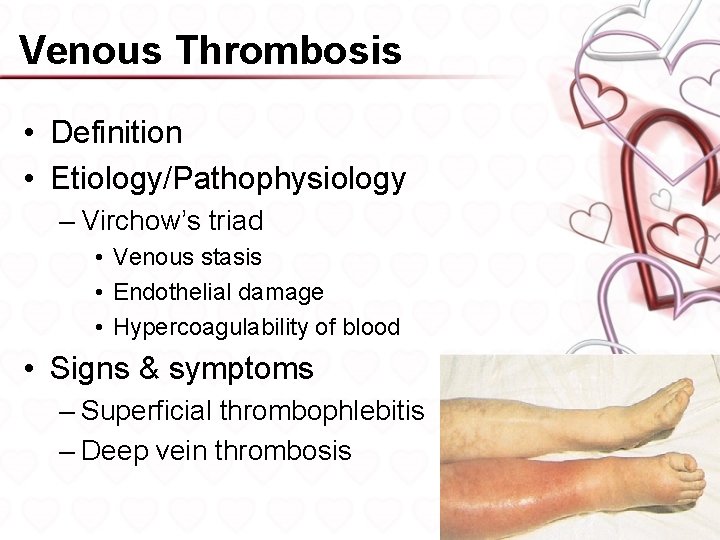 Venous Thrombosis • Definition • Etiology/Pathophysiology – Virchow’s triad • Venous stasis • Endothelial