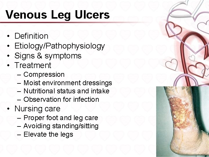 Venous Leg Ulcers • • Definition Etiology/Pathophysiology Signs & symptoms Treatment – – Compression