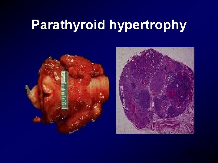 Parathyroid hypertrophy ESR 46 -21 