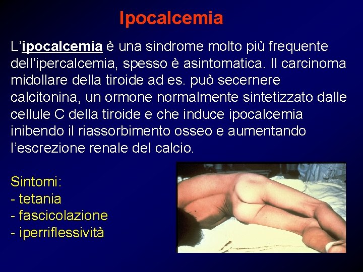 Ipocalcemia L’ipocalcemia è una sindrome molto più frequente dell’ipercalcemia, spesso è asintomatica. Il carcinoma