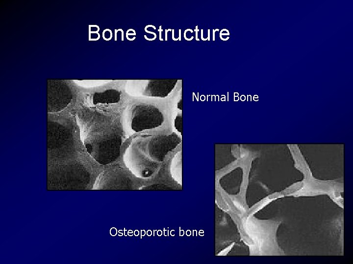 Bone Structure Normal Bone Osteoporotic bone 