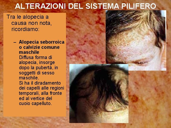 ALTERAZIONI DEL SISTEMA PILIFERO Tra le alopecia a causa non nota, ricordiamo: – Alopecia