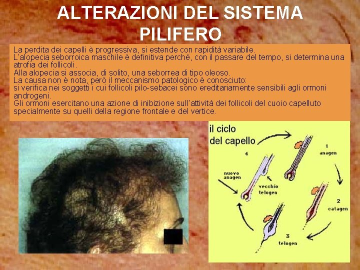 ALTERAZIONI DEL SISTEMA PILIFERO La perdita dei capelli è progressiva, si estende con rapidità