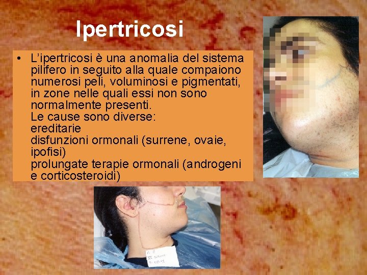 Ipertricosi • L’ipertricosi è una anomalia del sistema pilifero in seguito alla quale compaiono