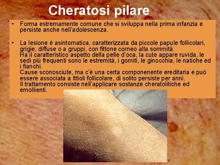 Cheratosi pilare • Forma estremamente comune che si sviluppa nella prima infanzia e persiste